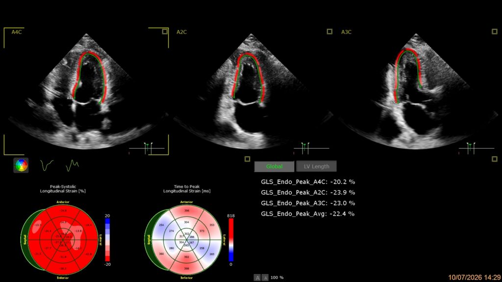 Análise de strain miocárdico em ecocardiograma